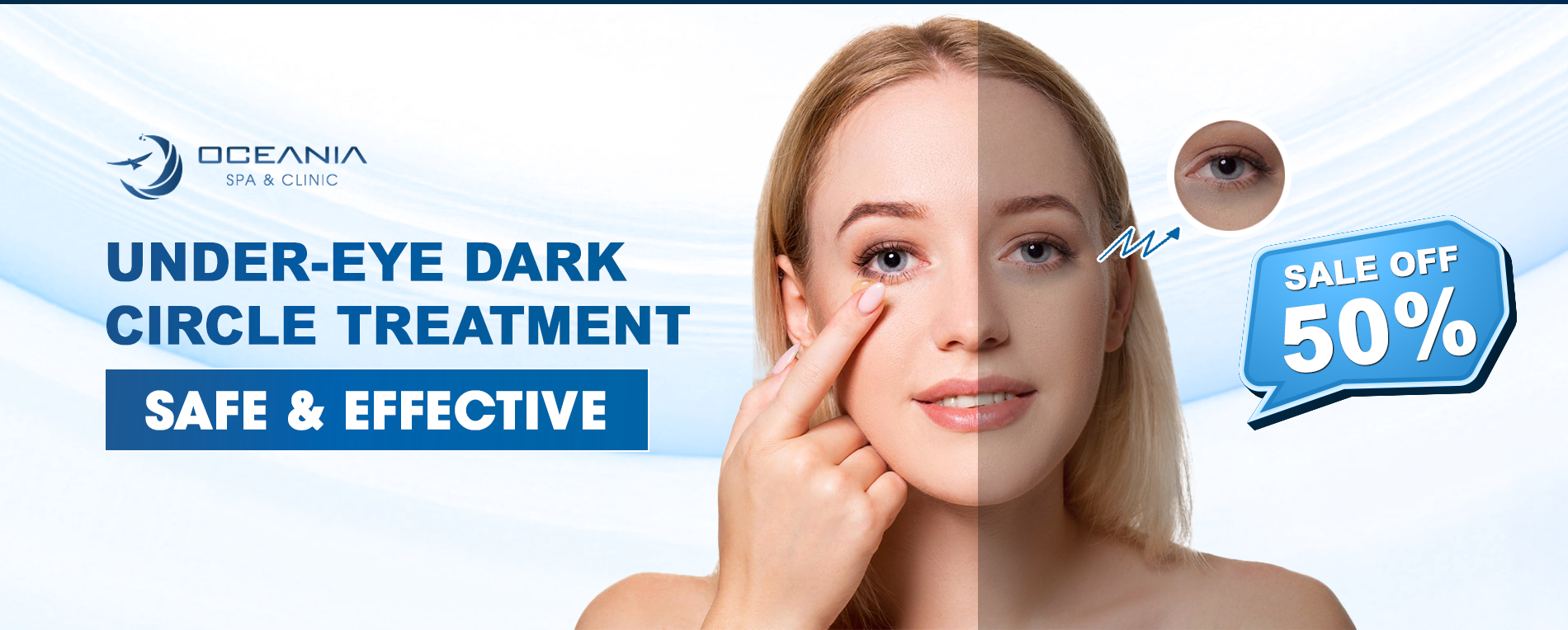 Điều trị quầng thâm mắt 1