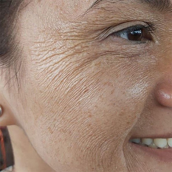 Da mắt khô, mất nước